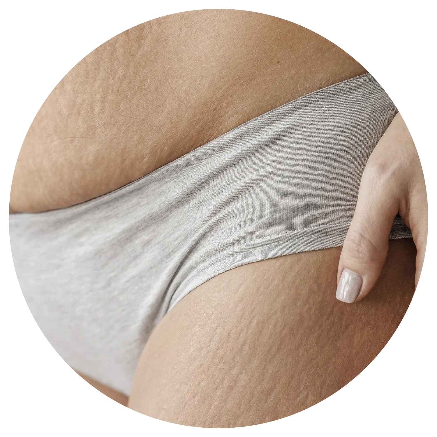 Stretch Marks treatment process at Toronto medical spa - Understand what's beneath the stretch.